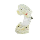 Complete Teeth Restoration Study with Dental Implant Model, Removable Bridge