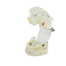 Complete Teeth Restoration Study with Dental Implant Model, Removable Bridge