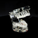 Complete Teeth Restoration Study with Dental Implant Model, Removable Bridge