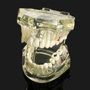 1pc Dental Implant Disease Teeth Model with Restoration & Bridge Tooth