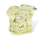 1pc Dental Implant Disease Teeth Model with Restoration & Bridge Tooth