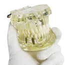 1pc Dental Implant Disease Teeth Model with Restoration & Bridge Tooth