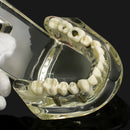 1pc Dental Implant Disease Teeth Model with Restoration & Bridge Tooth