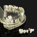 1pc Dental Implant Disease Teeth Model with Restoration & Bridge Tooth