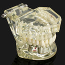 1pc Dental Implant Disease Teeth Model with Restoration & Bridge Tooth